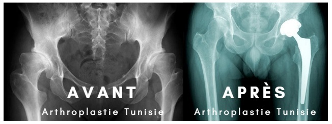 arthroplastie hanches tunisie