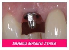 implants dentaires Tunisie