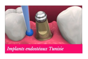 implant dentaire endosteaux Tunisie