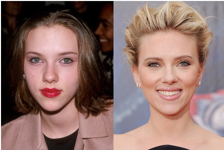 Scarlett Johanson et chirurgie esthétique