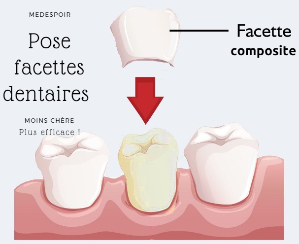 facettes dentaires composites Tunisie