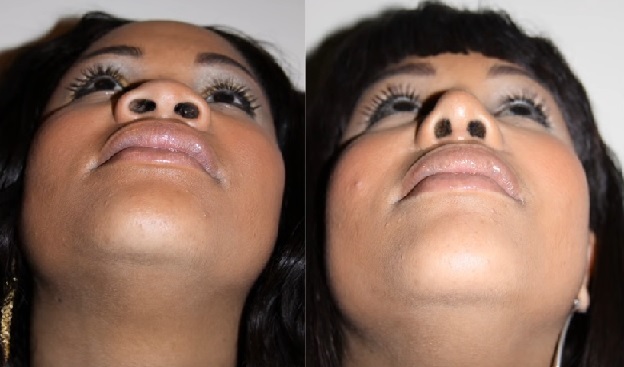 Rhinoplastie ethnique