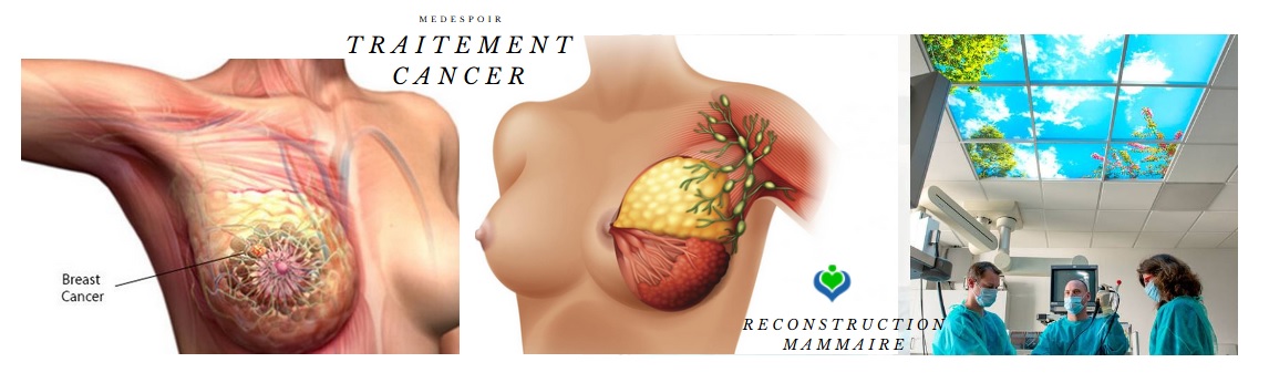 reconstruction seins par Medespoir