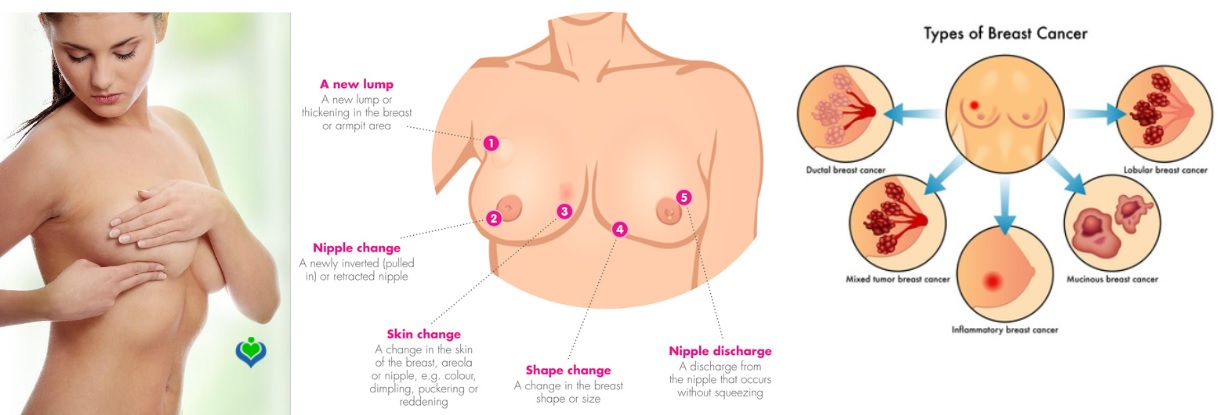 types cancer seins