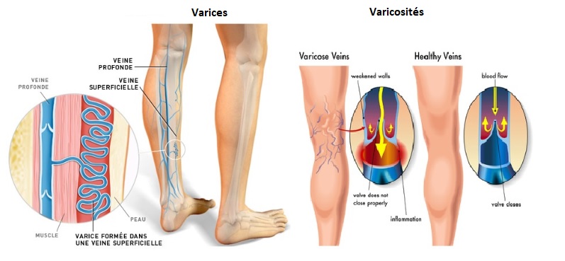 Varicosités