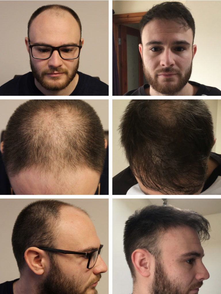 Photos avant et après traitement cheveux
