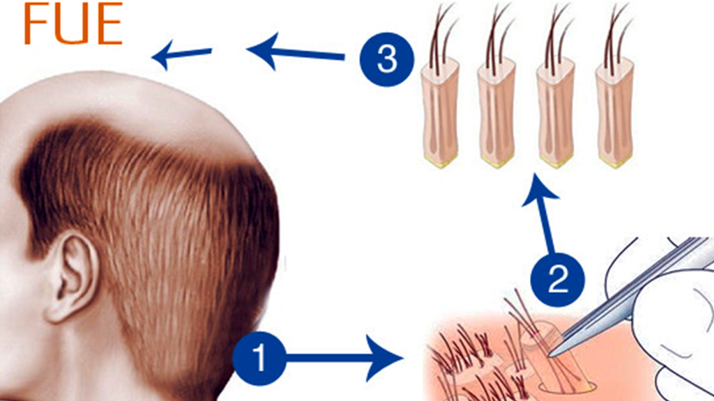 technique de fue : extraction follicules pileuses