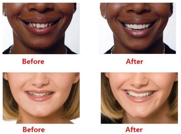 photos avant et après dentisterie esthetique
