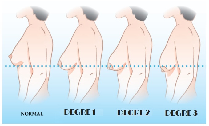 J'ai les seins tombants, quelles solutions de chirurgie esthétique ?, Institut du Sein