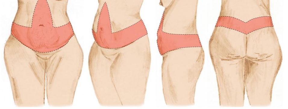 type d'abdominoplastie