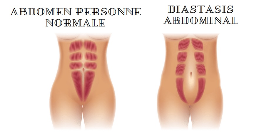 diastasis abdominal