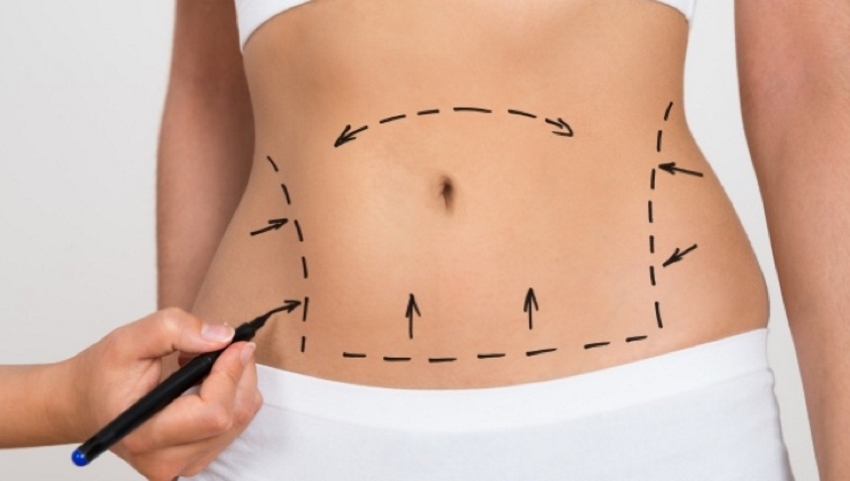 abdominoplastie Tunisie