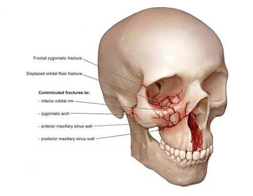 Blessures faciales