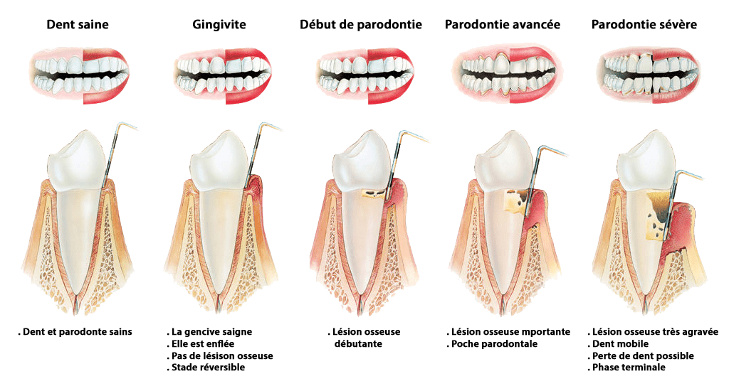 Gingivite et parodentite