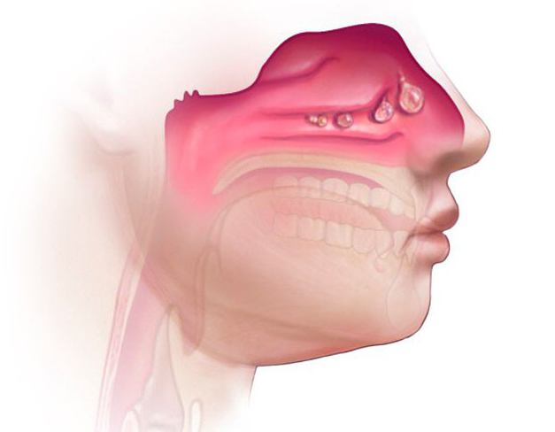 septoplastie rhinopathie hyper