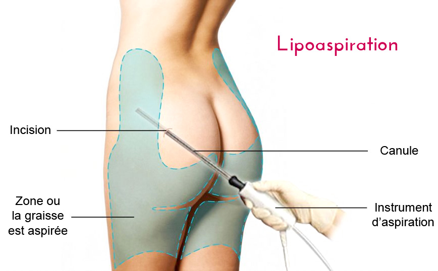 liposuccion