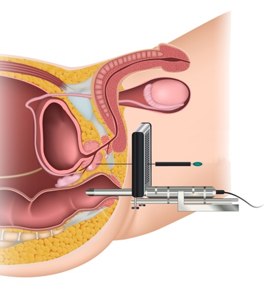 Biopsie prostate