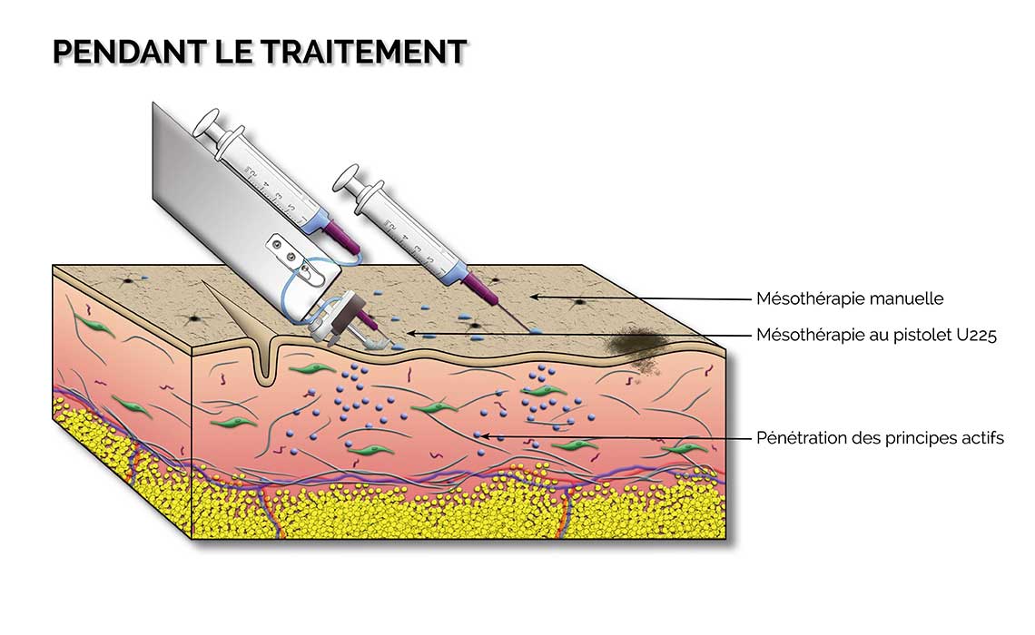 mesotherapie