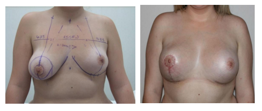 traiter asymétrie seins