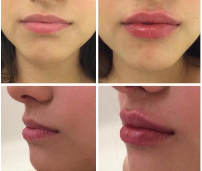 augmentation lèvres