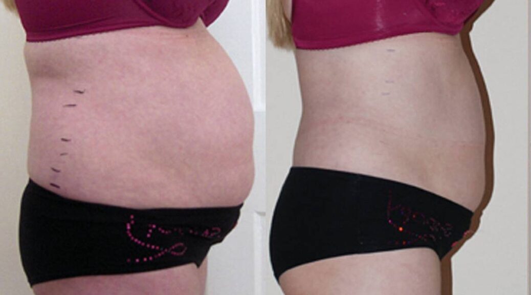 Lipo laser LIPOSUCCION