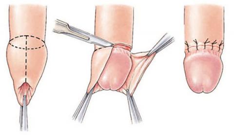 circoncision penis