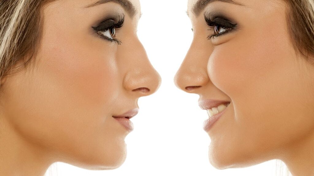 Rhinoplastie esthétique