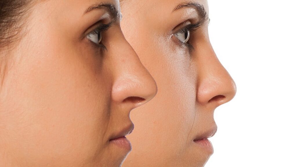 rhinoplastie Lausanne