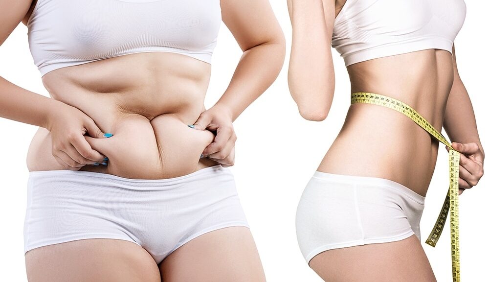 Abdominoplastie Genève