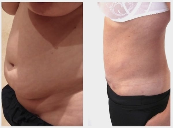 abdominoplastie suisse