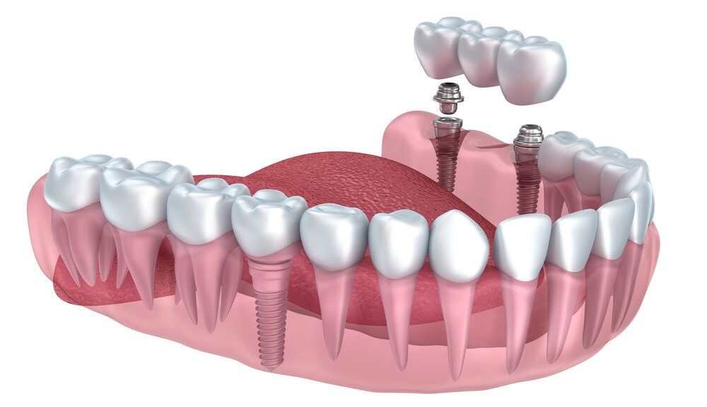 implant dentaire Zurich