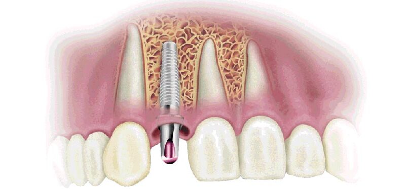 implant dentaire Geneve