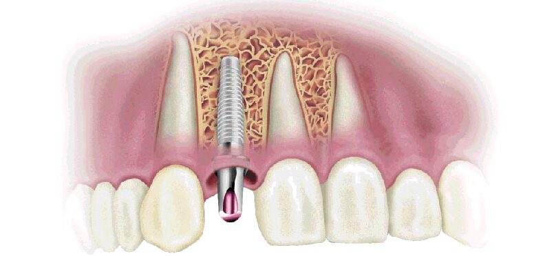 L'extraction dentaire – préservation osseuse avant la mise en place d'un  implant dentaire Le Perreux sur Marne (94170)