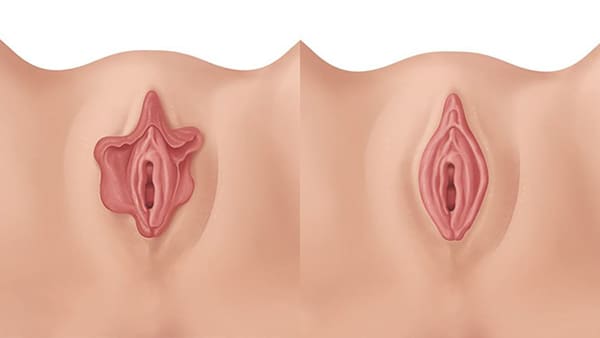 rajeunissement vaginal