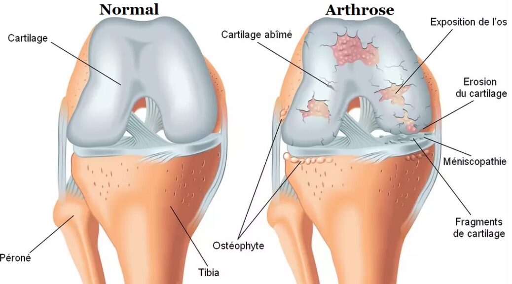 traitement arthrose