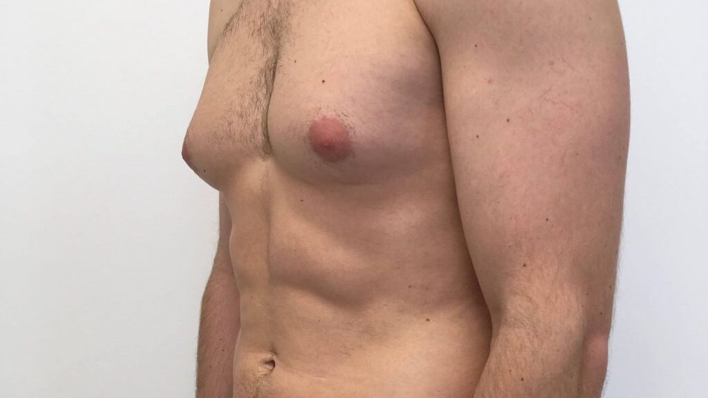 gynecomastie recuperation