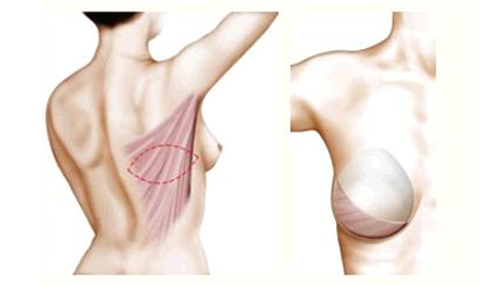 prix implants mammaires apres mastectomie