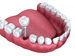 prix implant dentaire