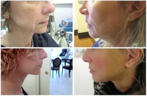 lifting cervico-facial et lifting cou