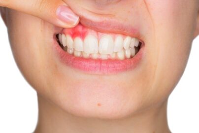 saignement dents