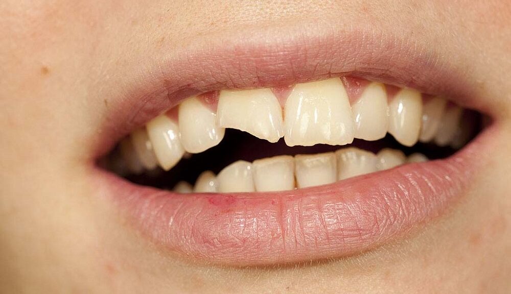 traitements dents traumatisées