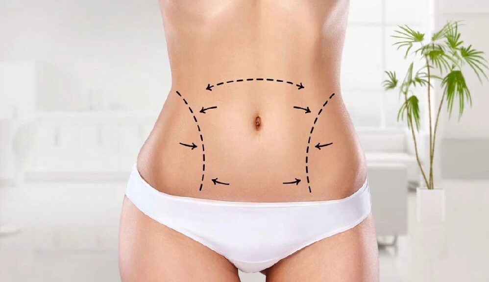 lipo