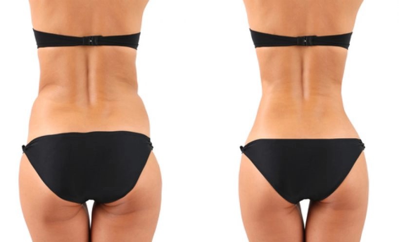 Abdominoplastie avec liposuccion pour Suisses