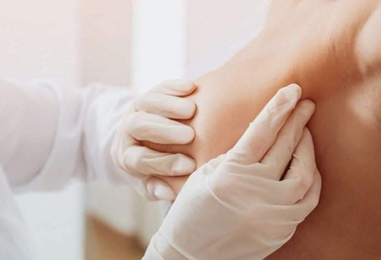 cancer mammaire et reconstruction sein