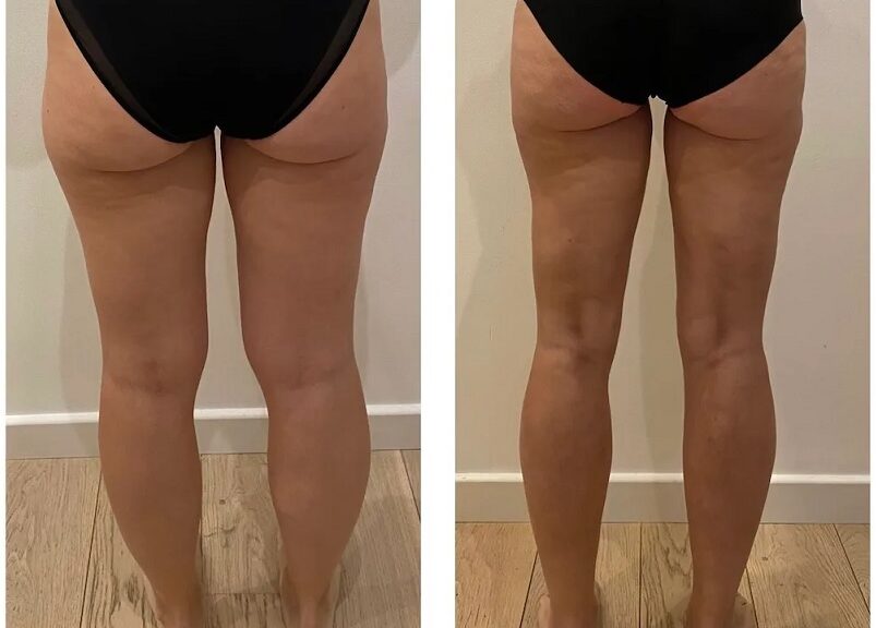 Chirurgie esthétique hanches et cuisses