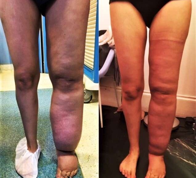 jambes eodemateuses
