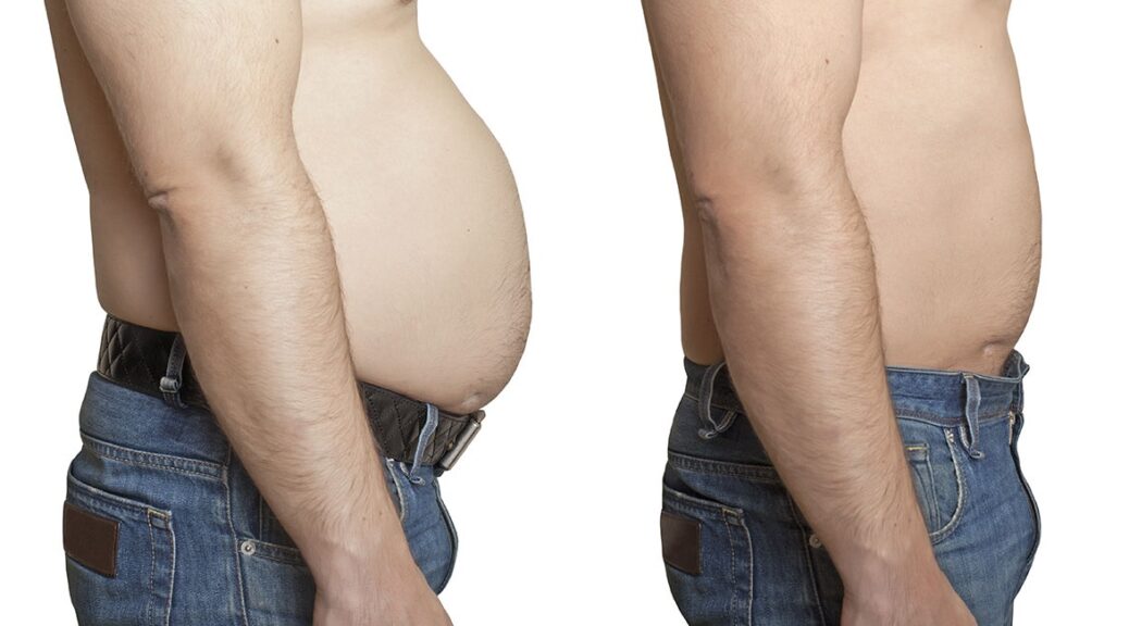 liposuccion abdominale Suisse