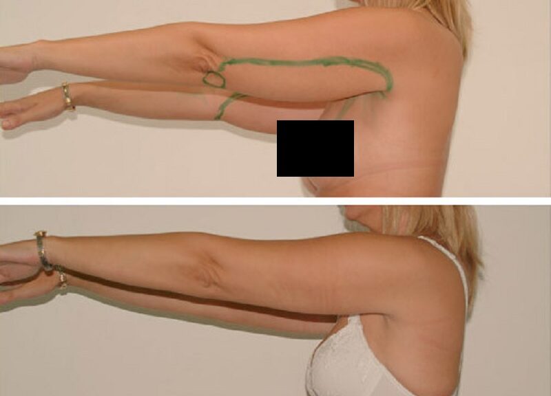 chirurgie esthetique liposuccion bras