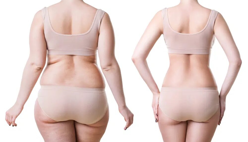 Liposuccion cuisses et hanches