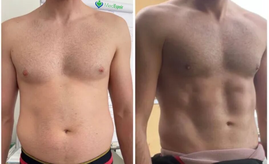lipoaspiration abdominale